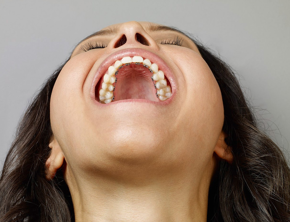 Lingual braces for adults